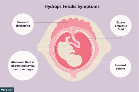 hidrops fetal